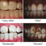 fluorosis-comp Photographs of Dental Fluorosis by Dr. Hardy Limeback and Dr. Iain Pretty, et al.